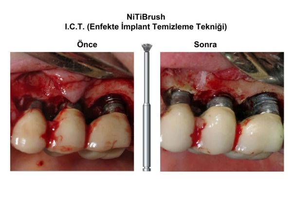 Nitibrush Peri-İmplantitis Frez Seti - 4 Adet
