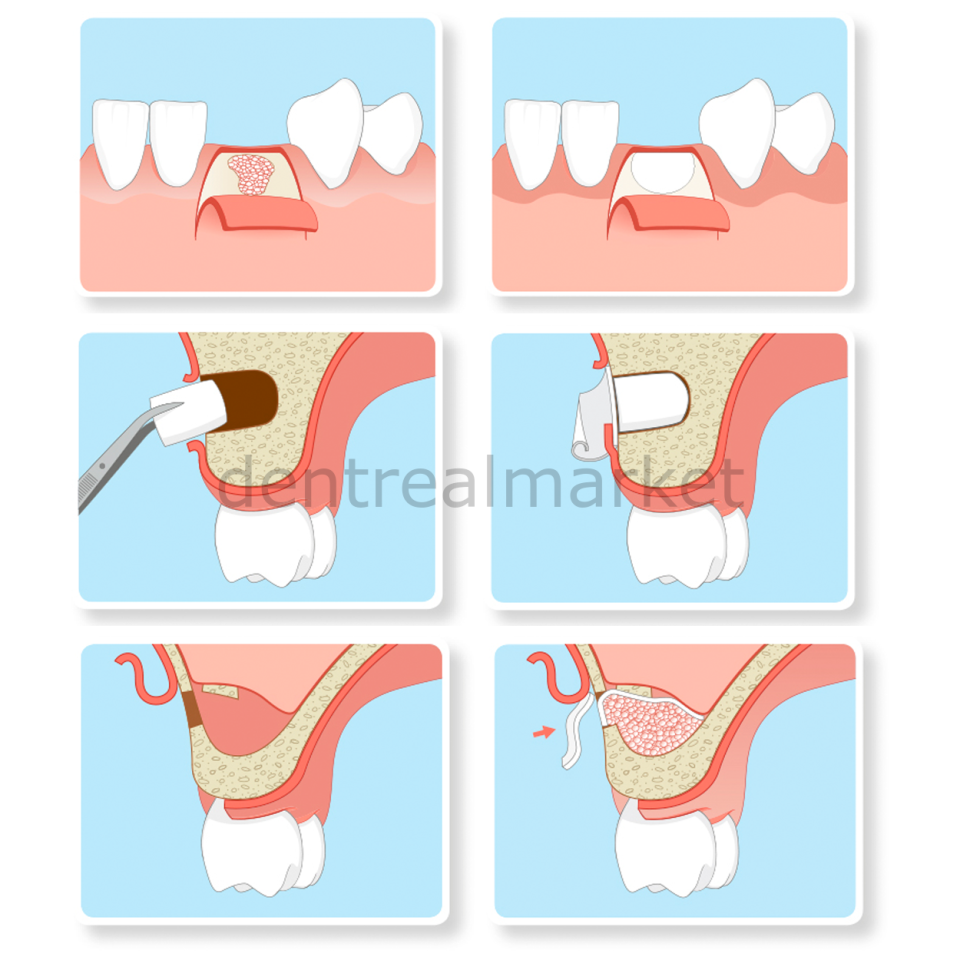 Parasorb Resodont Forte - Collagen Membran 32*25 mm