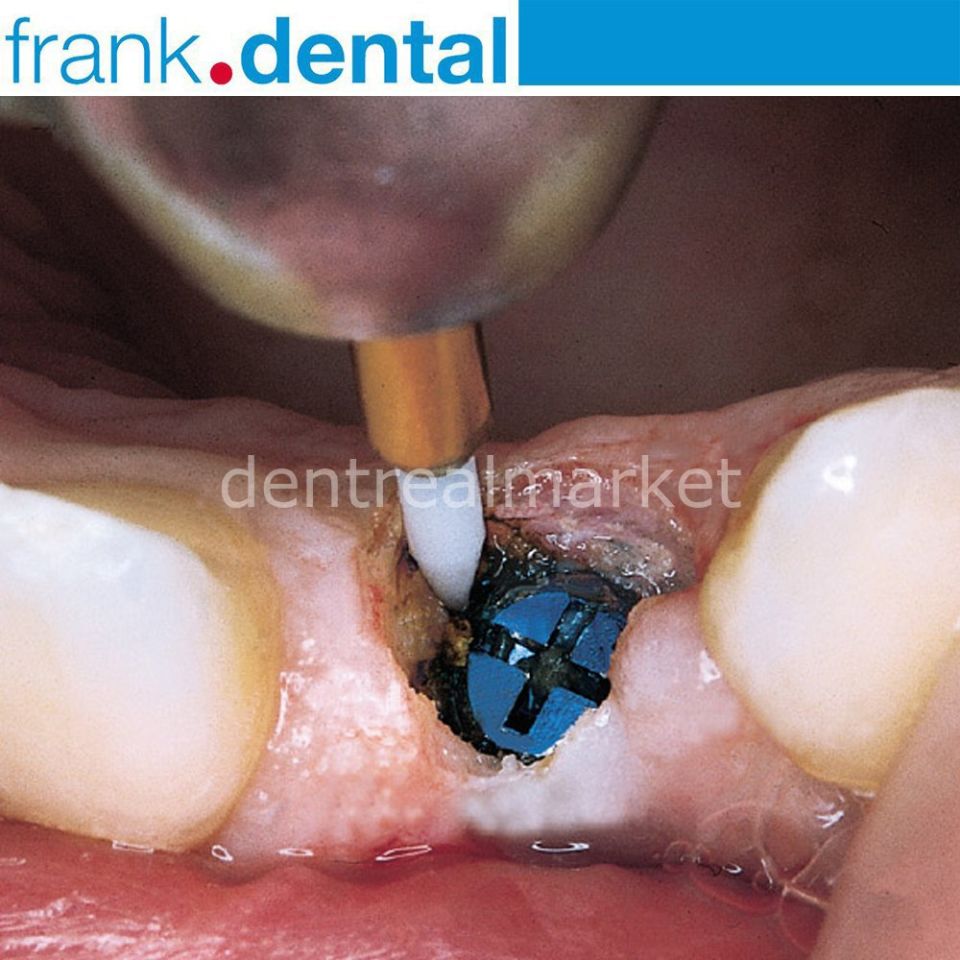 Gingiva Trimmer Yumuşak Doku Frezi - STT249